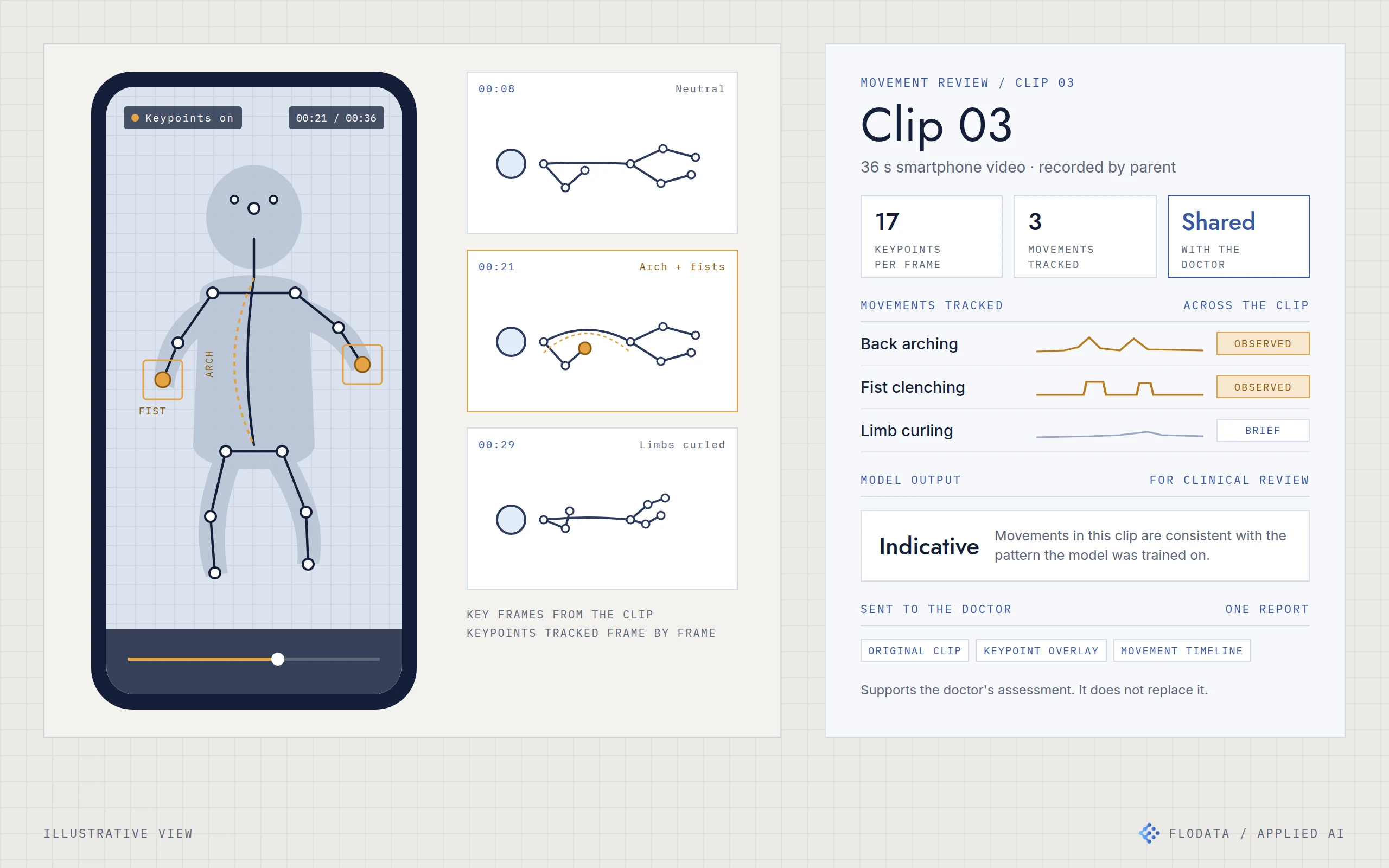Illustration of a smartphone playing a home video with a keypoint skeleton drawn over an abstract child figure, three key frames showing neutral, arched and curled positions, and a movement review card listing back arching, fist clenching and limb curling with the model output marked for clinical review.